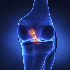 ACL Tear Treatment in Fort Worth, TX
