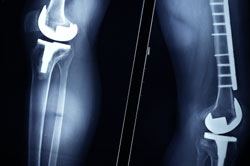 Computer Navigated Knee Replacement in Saddle River, NJ